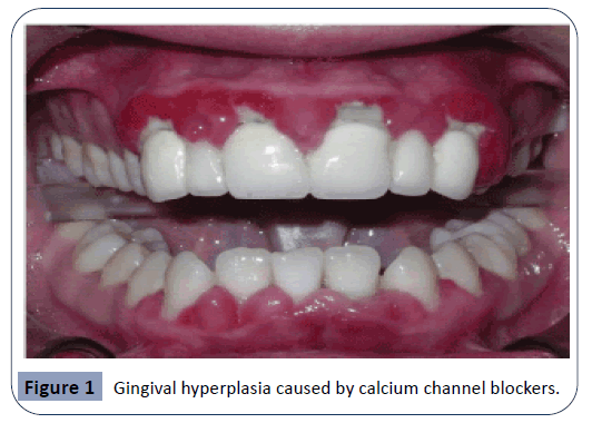 Review On Differential Diagnosis Of Drug Induced Gingival Hyperplasia And Other Oral Lesions Insight Medical Publishing