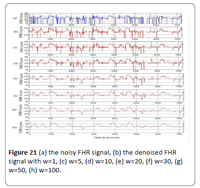 Rule Based Algorithm For Intrapartum Cardiotocograph Pattern Features Extraction And Classification Insight Medical Publishing